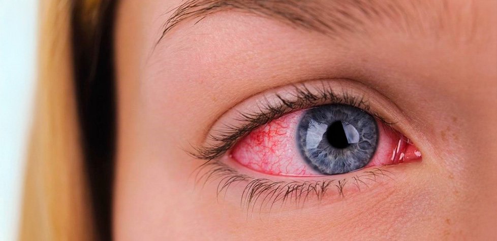 Hormônio pouco explorado surge como peça-chave na rosácea ocular e abre caminho para novos tratamentos 