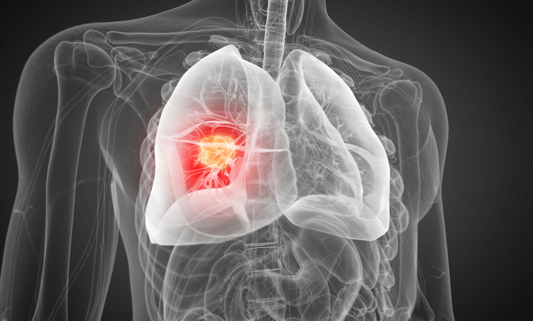 Brasil revela mapa genético inédito do câncer de pulmão e aponta desigualdades no acesso a terapias-alvo 