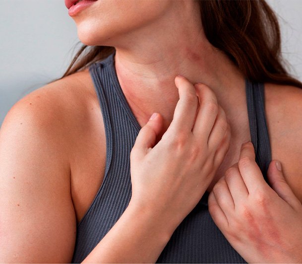 Mapa inédito da dermatite atópica revela células-chave da inflamação e abre caminho para novos tratamentos