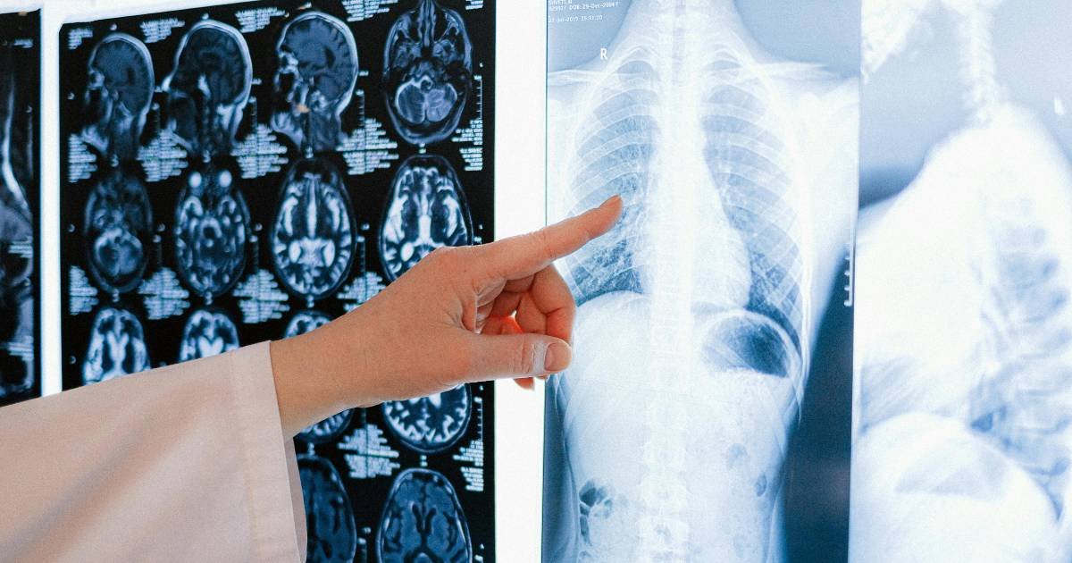 Exame de imagem antecipa agressividade de câncer de pulmão e pode redefinir decisões cirúrgicas  