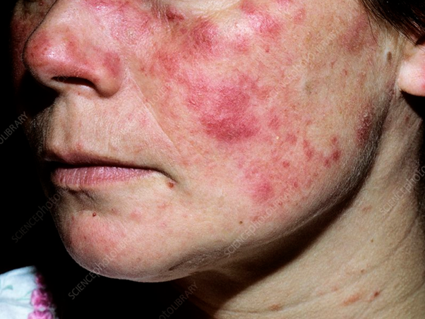 Atlas inédito do lúpus revela 'mapa' da inflamação na pele e aponta novos alvos terapêuticos 